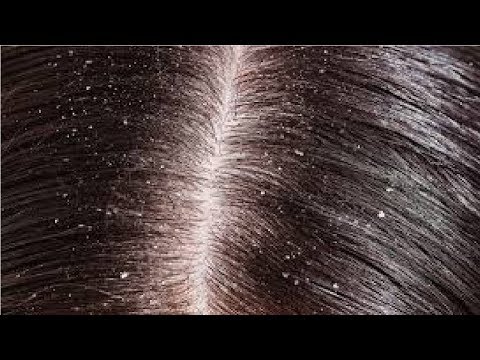 how to get rid of dandruff without washing hair
