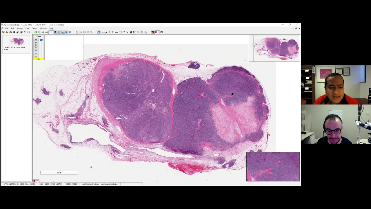 Fresh Air with the Lung Path Guys. Episode 2: Thymoma