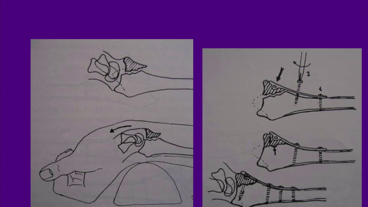 Перелом смита и колеса презентация