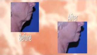 Face Lift Fort Wayne IN - Call (260) 489 0099 Wealth