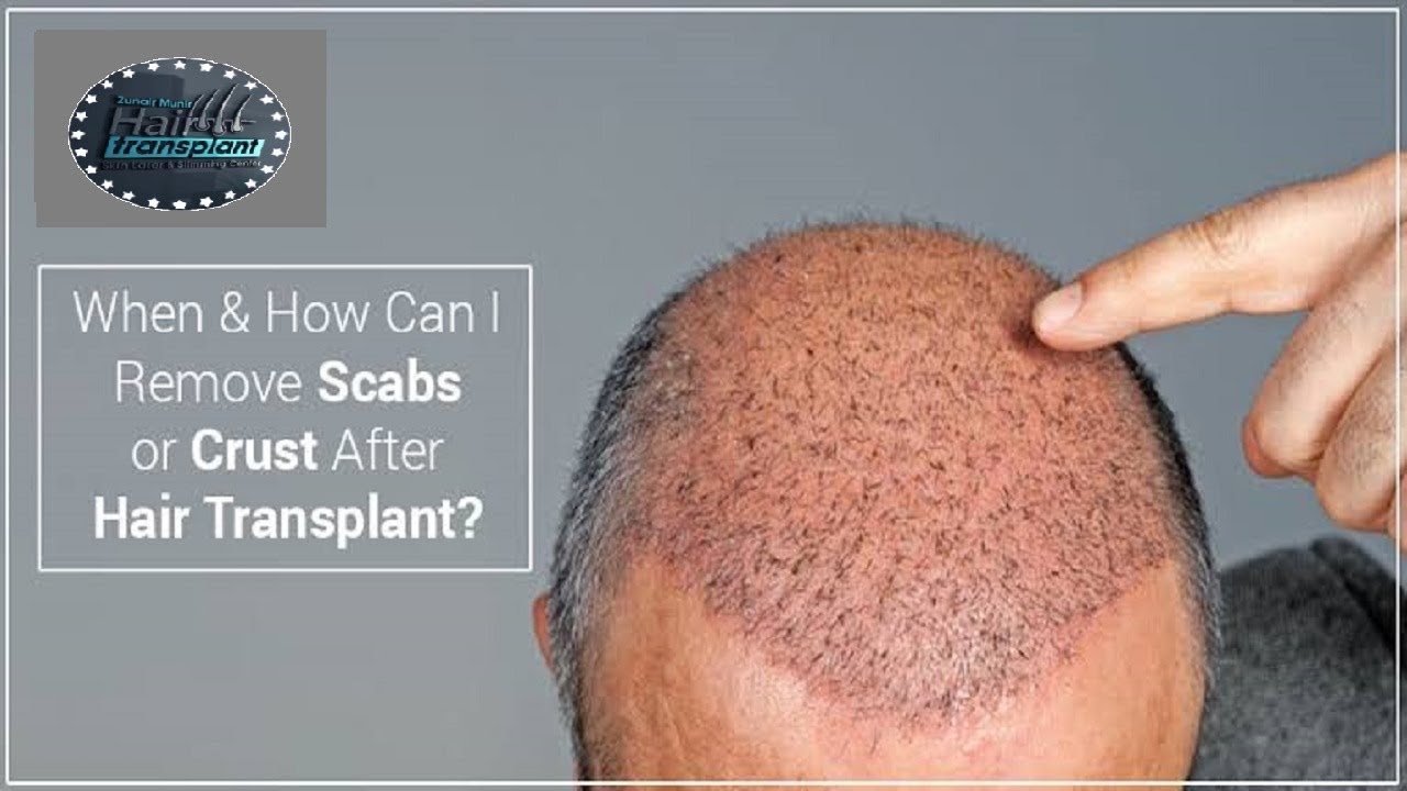 How Can I Remove Scabs Or Crust After Hair Transplant || Zunair Aesthetics