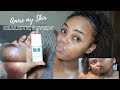 How to Get Rid of Acne Scars Fast | Admire My Skin Review