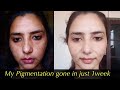 1 हफ़्ते में ही झाइयाँ ग़ायब हो गयी आपकी Diet से। My Pigmentation/Melasma gone in just 1 week.