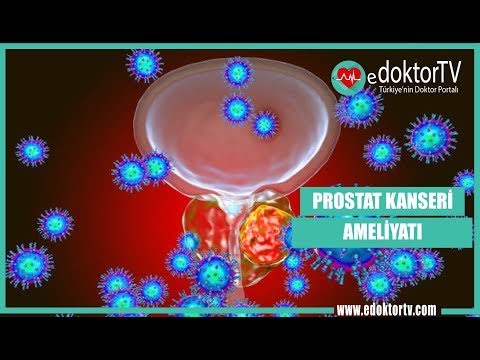 PROSTATE CANCER SURGERY (prostate therapy)