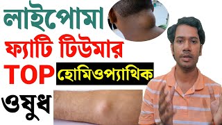 Lipoma treatment in Homeopathy |Homeopathic Medicine For Lipoma | Lipoma Homeopathic Treatment | screenshot 4