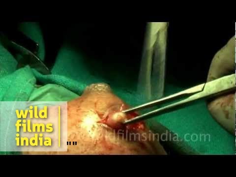 Breast cyst removal Breast cyst removal