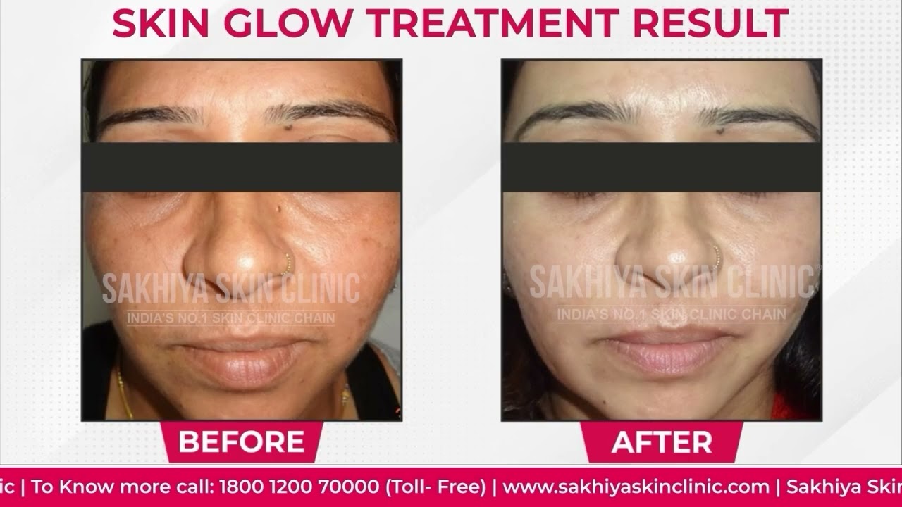 Pigmentation Treatment Success Story | Real Patient Review | Sakhiya Skin Clinic
