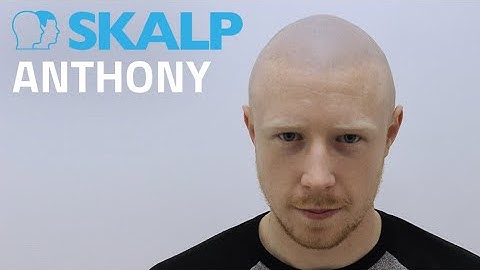 Is scalp micropigmentation permanent? Scalp Micropigmentation Testimonial by Skalp® Anthony’s video