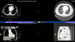PACS - CT Thorax