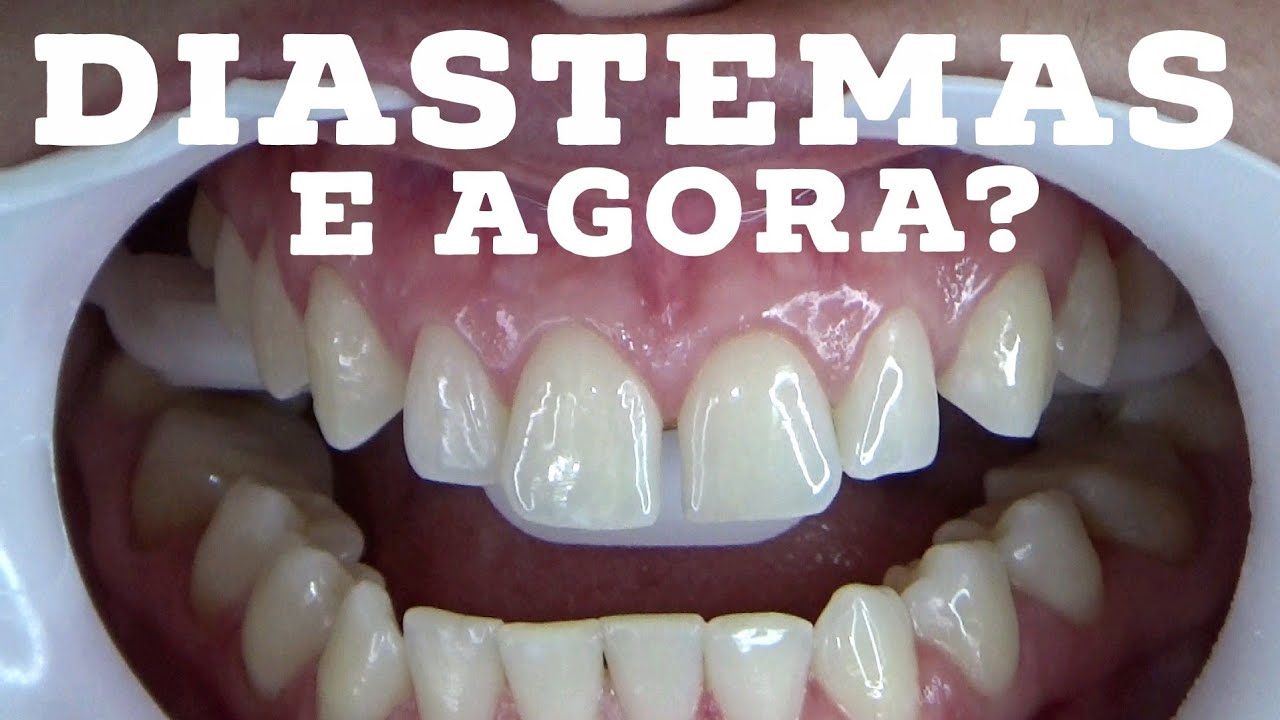 🛑COMO FECHAR DIASTEMAS COM UMA GUIA SUPER RÁPIDA🤩🔥🔥🔥