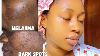 How to clear Melasma & Hyperpigmentation in days😳|Products that works How I Cleared My Melasma Hyperpigmentation