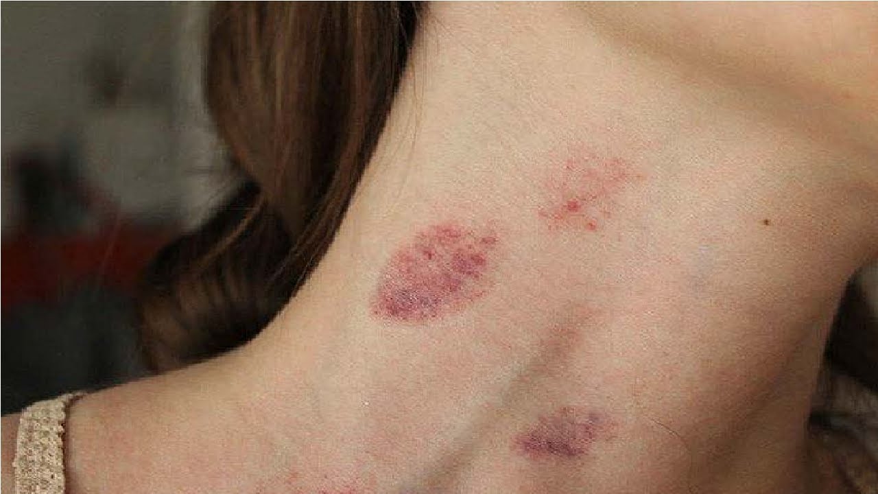 how to get a hickey by yourself