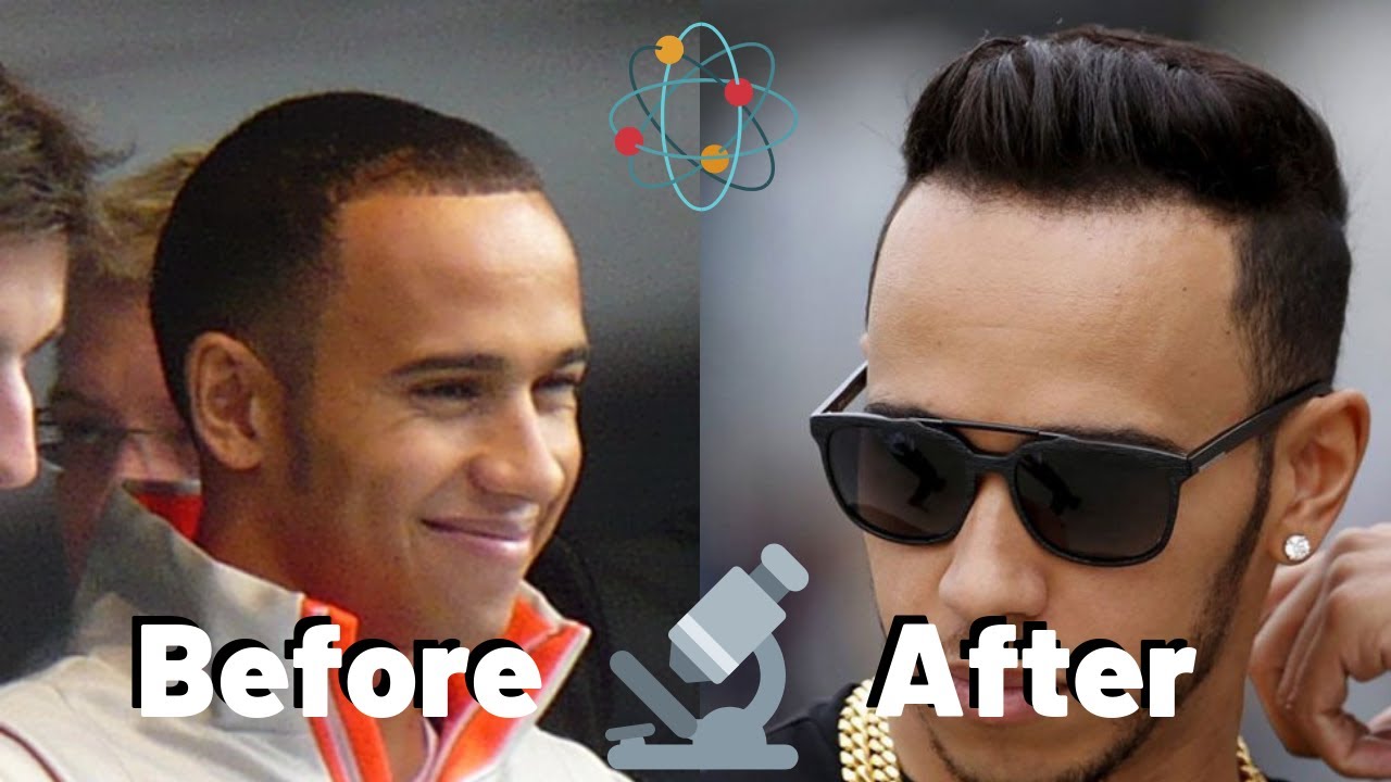 Lewis Hamilton Hair Transplant Everything You Need to Know
