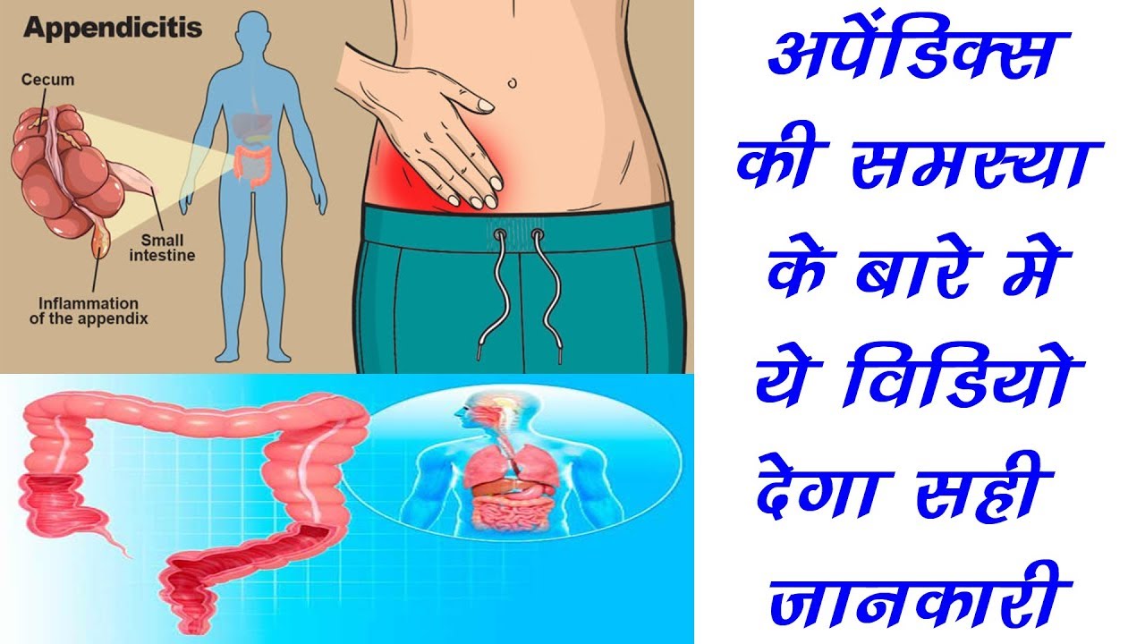 Apendix की समस्या के बारे में ये वीडियो देगा सही जानकारी - YouTube