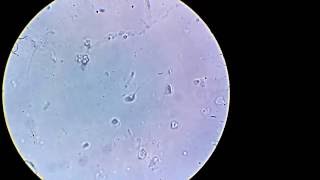 Abnormal Sperm Morphology. Espermatozoides Anormales.