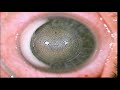 CLEAR | Live laser eye surgery | Doctor Kostenev