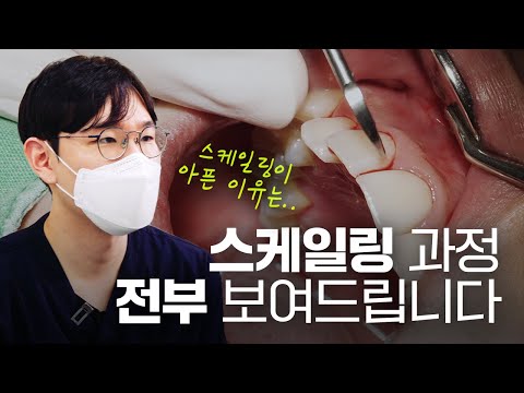 스케일링 받다가 피🩸 본 적 있는 사람✋🏻 드루와 드루와| 피 나는 이유 알려드립니다!