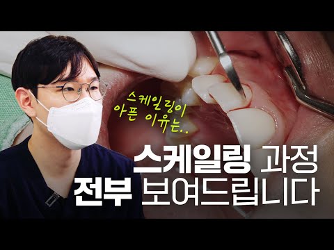   스케일링 받다가 피 본 적 있는 사람 드루와 드루와 피 나는 이유 알려드립니다