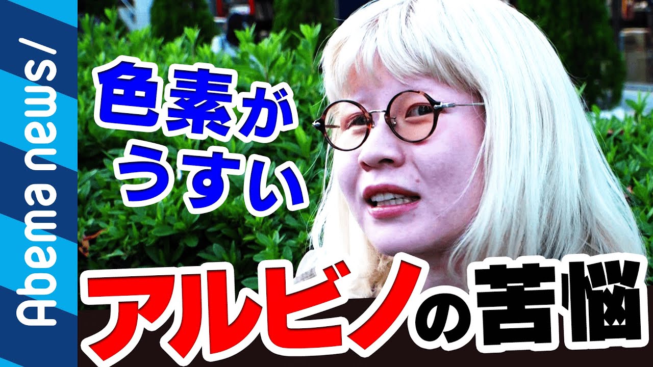 アルビノ 短命 アルビノの日本人は寿命が短いって本当 寿命が短いと言われる理由は