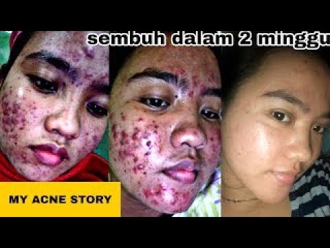 SKINCARE AMPUH ATASI JERAWAT,BRUNTUSAN DAN MINYAK BERLEBIH | PURE SKIN DARI ORIFLAME. 