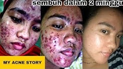 MY ACNE STORY |JERAWAT HILANG DALAM 1 BULAN by Mawar â¥ï¸ - Durasi: 9.07. MY ACNE STORY |JERAWAT HILANG DALAM 1 BULAN by Mawar â¥ï¸ - Durasi: 9.07.