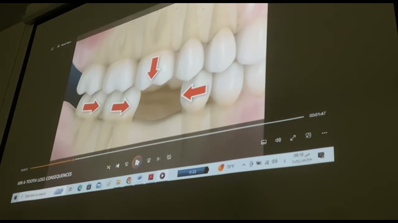 DM : PRACTICAL, TOOTH LOSS CONSEQUENCES , OCCLUSION MUTUAMENTE PROTEGIDA 