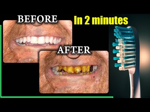 In 2 minutes, yellow will make dirty teeth white like pearl and shiny. how to whiten teeth