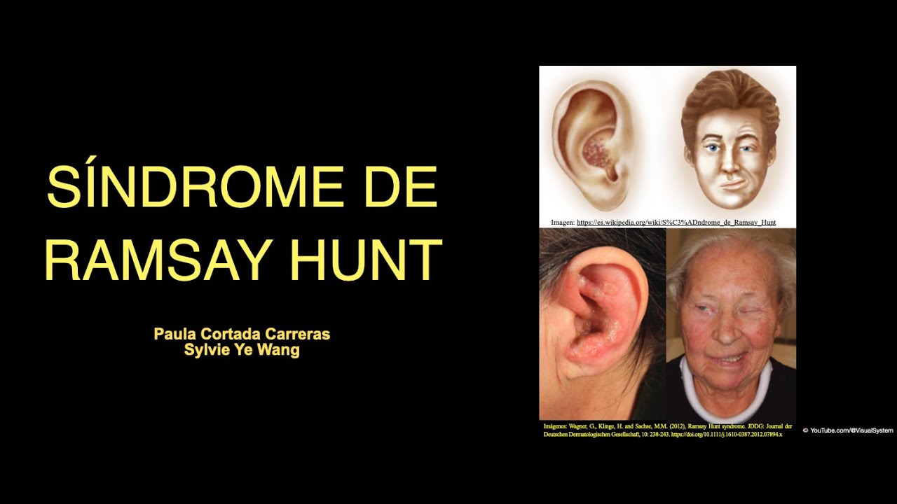 Sindrome De Ramsay Hunt sindrome-de-ramsay-hunt