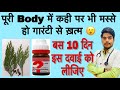 Warts homeopathic treatment in hindi  best medicine for warts     