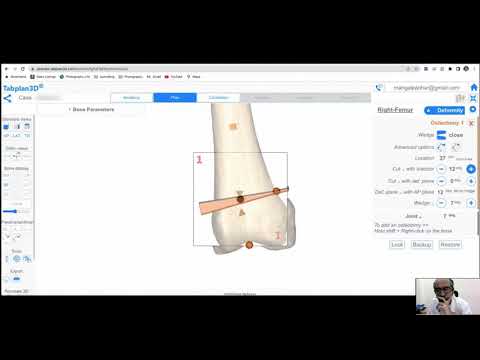 Distal Femur Osteotomy (DFO) - Fixation by Plate and Auto-design of Custom Jig (PSI) - video from Algosurg