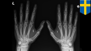 Mark of the Beast? Swedish office complex implanting microchips into hundreds of employees