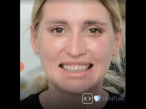 Digital Smile Simulation - Dentum Klinika Zagreb