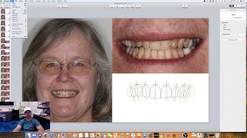 Keynote - Smile Design Part 3 - Completing the Smile Design