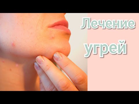 Угри пройдут. Очень простое и эффективное средство!