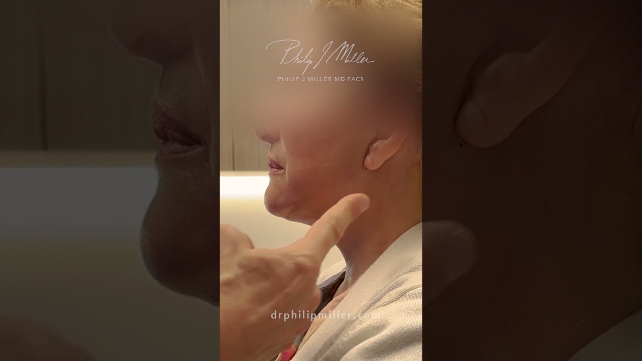 One Month Deep Plane Facelift And Necklift Transformation With My Happy 65-year-old NYC Patient