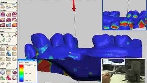 Removable CoCr Prosthodontics - Survey and Block Out