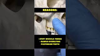 How to extract teeth in reduce mouth opening #extraction #reducemouth#forceps #oralsurgery