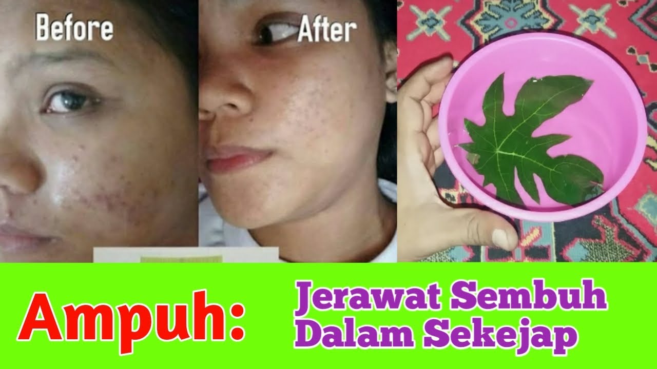 Cara Mudah Menghilangkan Jerawat - Macam Khasiat 