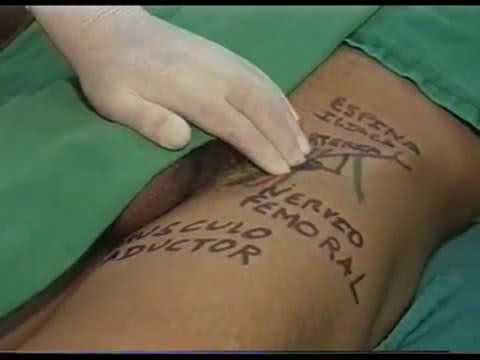 Vídeo: Comparación Entre Analgesia De Infiltración Local Con Bloqueo Combinado Del Nervio Femoral Y Ciático Para El Manejo Del Dolor Después De La Artroplastia Total De Rodilla