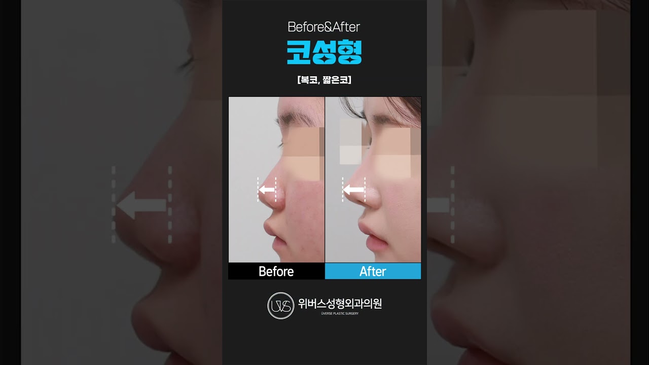 [Виверс гоо сайхны мэс заслын клиник] 💗Хамрын гоо сайхны мэс засал💗 Булбагар, богино хамар