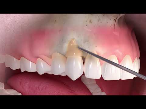 Video: Come rafforzare denti e gengive (con immagini)