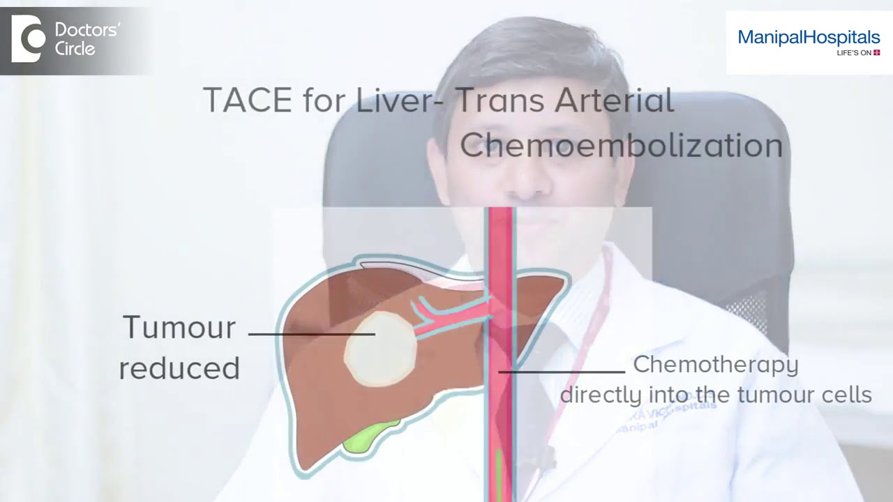 TACE For Liver Cancer   Dr Ravichand   Liver Transplant Surgeon in Bangalore   Manipal Hospitals