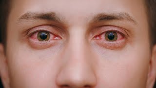 How Conjunctivitis Damages our Eye (Pink Eyes Disease) l Symptoms and Treatment l