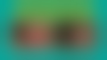 Managing Conjunctival Pyogenic Granulomas