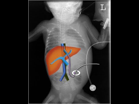 X-ray & US of Umbilical Venous Catheter (Part-1)