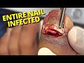 Careful REMOVAL Of Thick, Darkened, Infected TOENAIL!