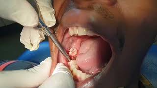 Removing a very rotten tooth using  elevator