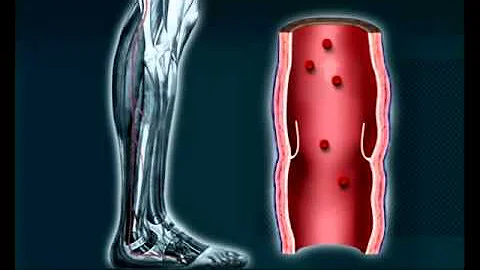 How Compression Socks Helps