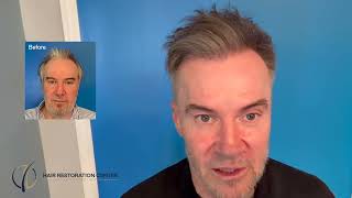 Life Changing Hair Restoration Results - Dr. Scott Boden