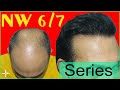 Hair Transplant Result's of Grade 6/7 More Than 1000 Cases @Eugenix By Expert Hair Surgeons